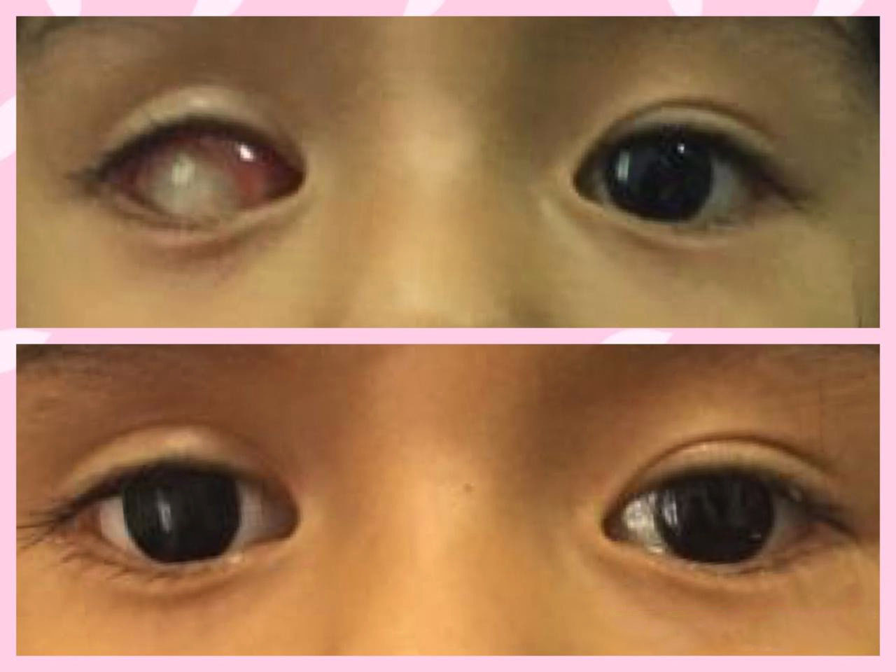 protesis_ocular-implante