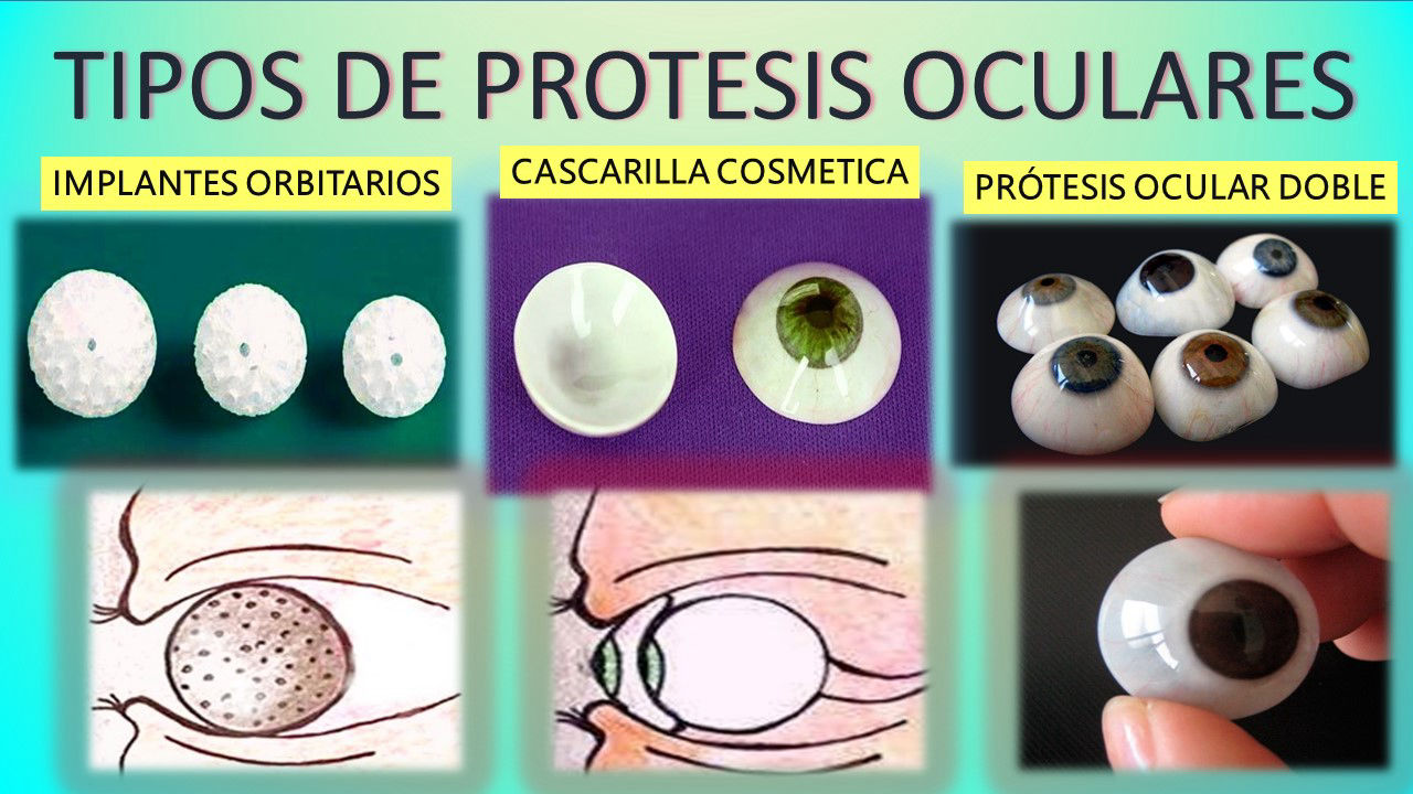 protesis_oculares